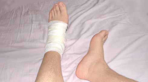 脚扭伤怎么办 脚扭伤的治疗方法