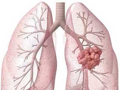 最新研究:引发肺癌的生物学机理被揭示